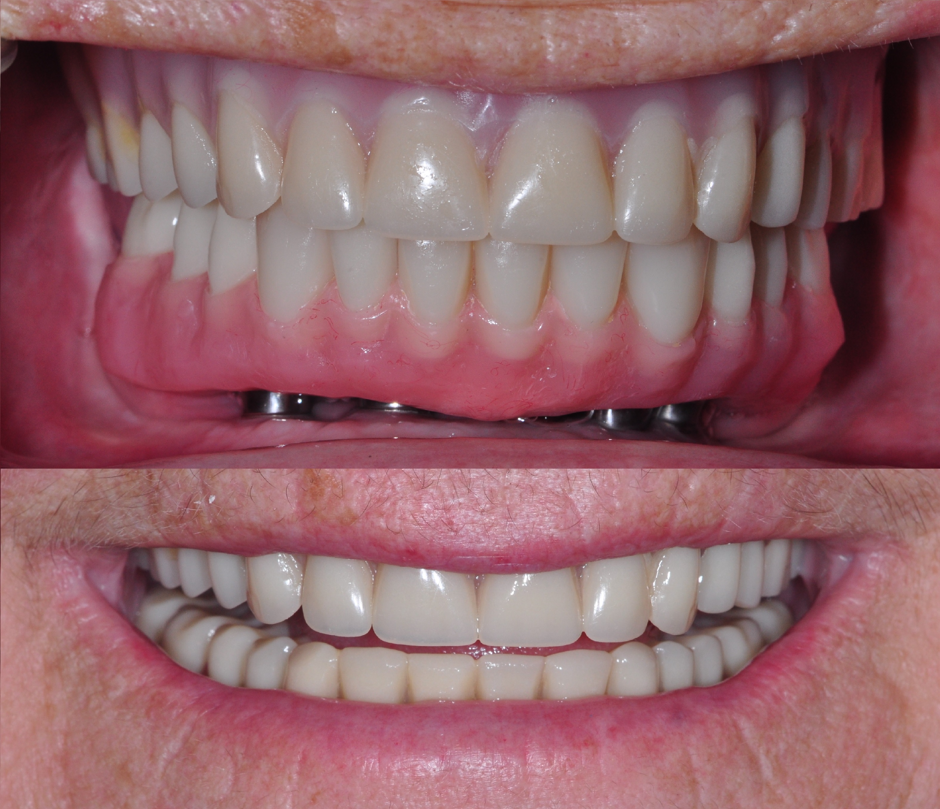 Lower Denture over Implants
